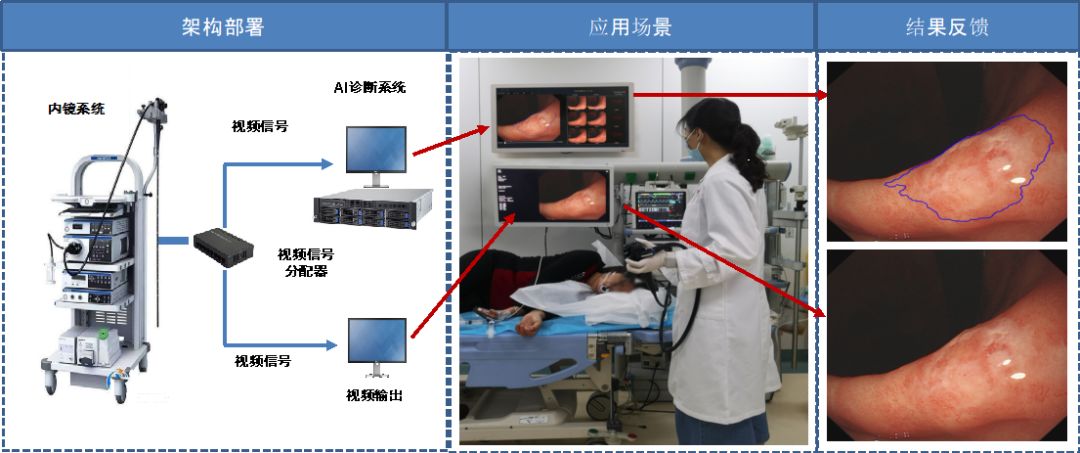 腫瘤早診的“火眼金睛”——徐瑞華教授團隊成功研發(fā)上消化道腫瘤內鏡AI輔助診斷系統(tǒng)-肽度TIMEDOO