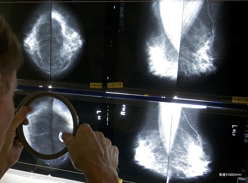 德研究:定期接受乳腺X線篩查可顯著降低乳腺癌死亡率-肽度TIMEDOO