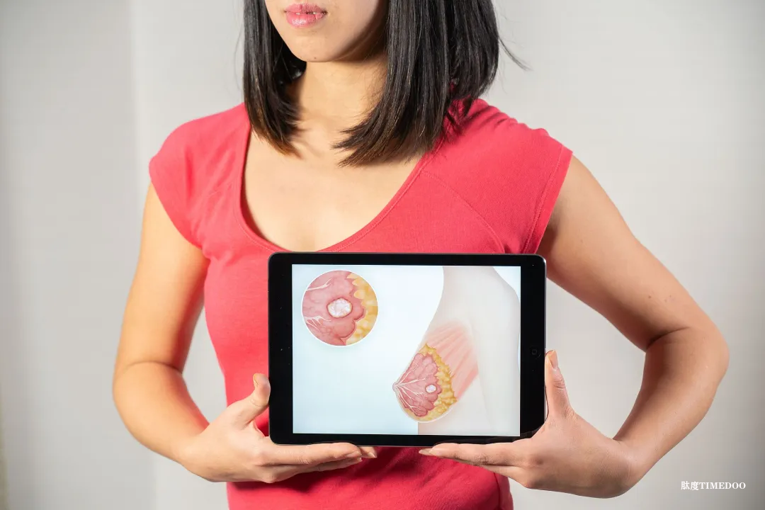 德研究:定期接受乳腺X線篩查可顯著降低乳腺癌死亡率-肽度TIMEDOO